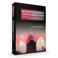 Reconstrução Alveolar Proteticamente Guiada - A Regeneração Óssea E Estética Após Exodontias Sem Enxertos, Membranas E Retalhos