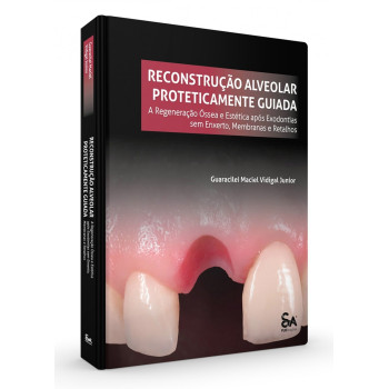 Reconstrução Alveolar Proteticamente Guiada - A Regeneração Óssea E Estética Após Exodontias Sem Enxertos, Membranas E Retalhos